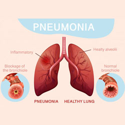 Pneumonia