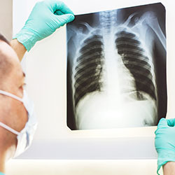 Interstitial Lung Disease